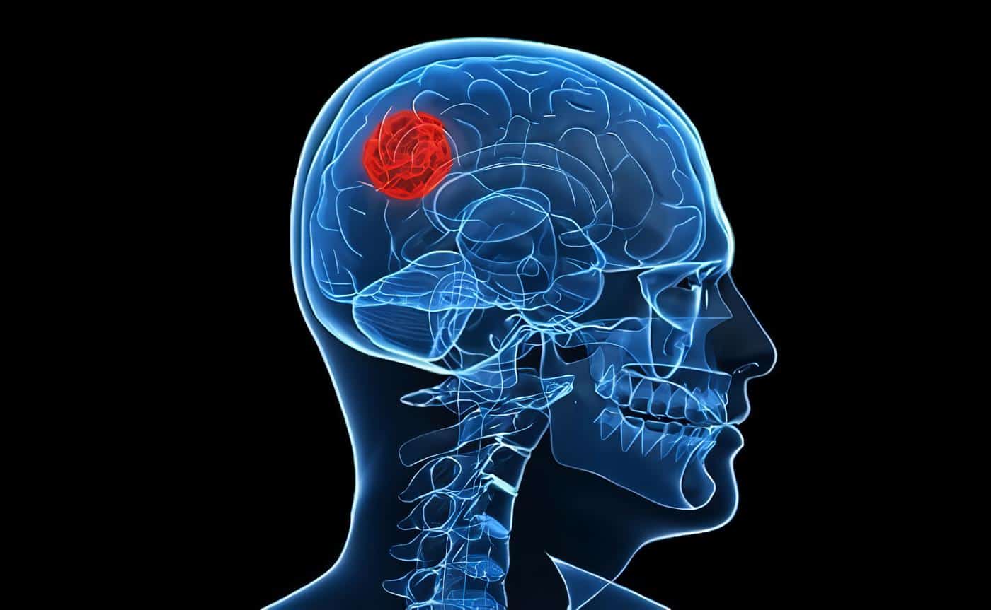 Las alergias protegerían contra cierto tipo de cáncer cerebral Las alergias protegerían contra cierto tipo de cáncer cerebral
