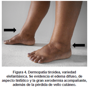 Mixedema
