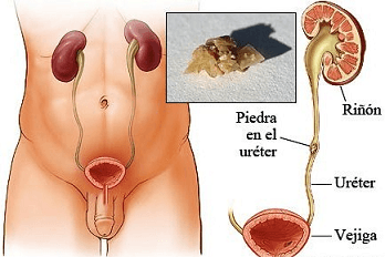 vu-082 - Cálculos Coledocolitiasis