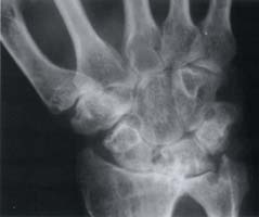 Disminución del espacio articular radiocarpiano e intercarpianos, múltiples erosiones en los huesos del carpo, entre ellos el trapecio en su porción radial y distal. Disminución del espacio articular radiocarpiano e intercarpianos, múltiples erosiones en los huesos del carpo, entre ellos el trapecio en su porción radial y distal.